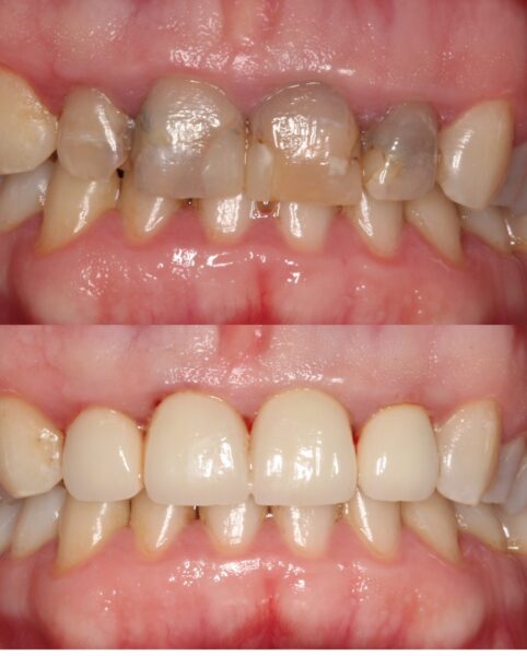 Poprawa estetyki uśmiechu za pomocą koron i licówek porcelanowych