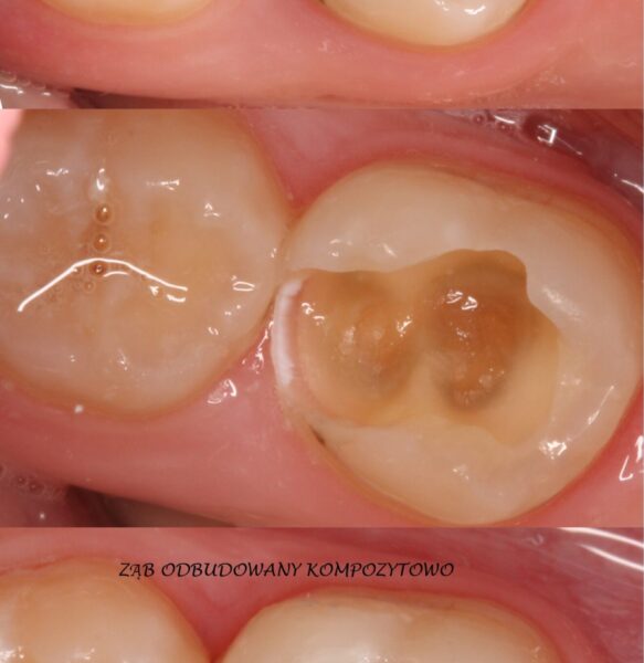 Odbudowa kształtu i funkcji zęba