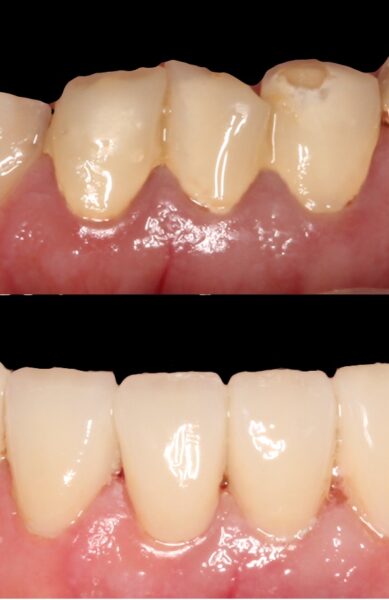 Poprawa estetyki uśmiechu za pomocą koron i licówek porcelanowych