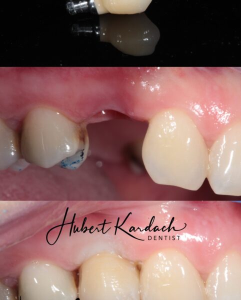 implant 14