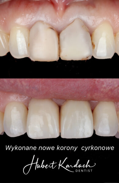 korony11-21
