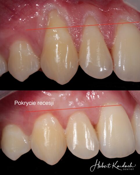 pokrycie recesji 12-13-14